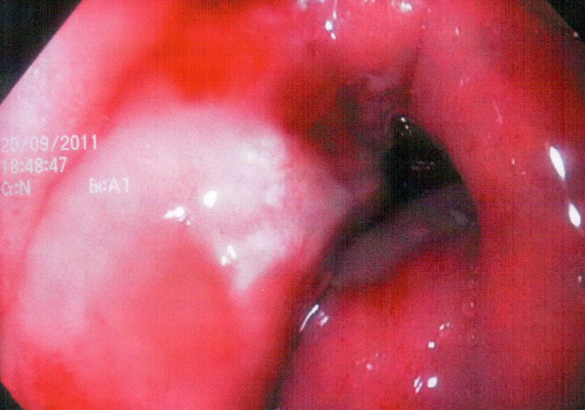 Рис 8 – Гигантская язва желудка в зоне: нижняя треть желудка с признаками пенетрации и продолжающегося кровотечения.